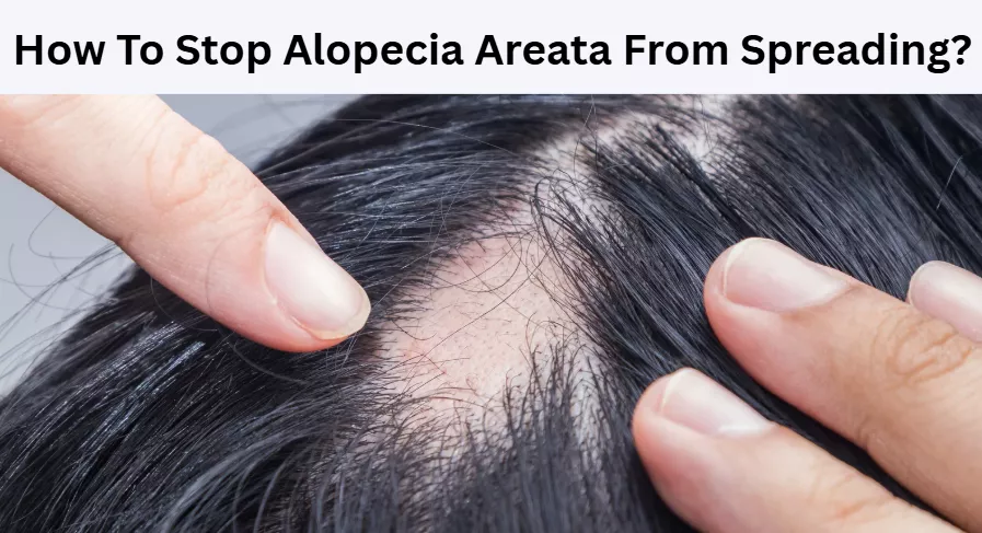 How To Stop Alopecia Areata From Spreading