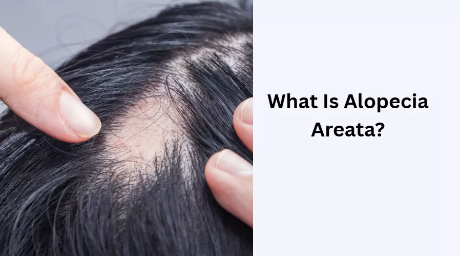 What Is Alopecia Areata?